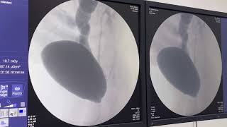 Uretrocistografia retrógrada miccional UCM em paciente com Refluxo vésico ureteral [upl. by Oderfodog413]