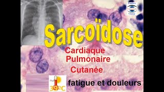 Sarcoidose pulmonaire articulaire renale hepatique cutanée ophtalmologique [upl. by Jannel316]