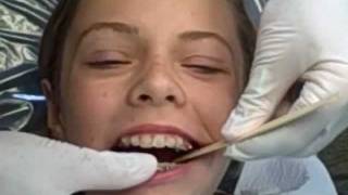 How A Herbst Appliance Is Placed Manley Orthodontics [upl. by Yecak]