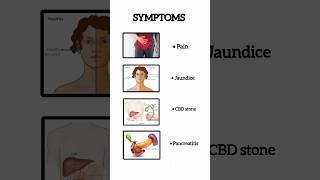 Gall bladder stones  When to get surgery done [upl. by Gavrah301]