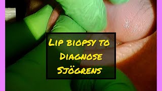 Lip Biopsy to Help Diagnose Sjögrens Disease [upl. by Haroldson]