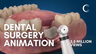 Dental Surgery Animation  Bone Grafting [upl. by Tuesday]