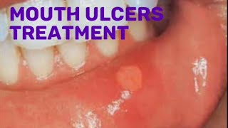 Drugs for mouth ulcers treatment pharmacist pharmacy [upl. by Gibb]