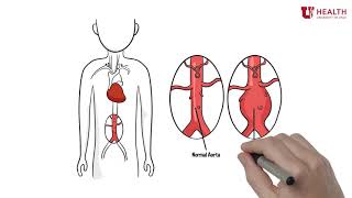 Abdominal aortic aneurysms  Circulatory System and Disease  NCLEXRN  Khan Academy [upl. by Cardwell]