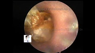 Common cerumen embolism and cholesteatoma reexamination and cleaning9mins 20230112 [upl. by Eleonore]