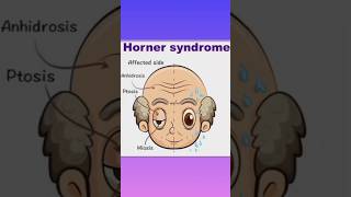 Horner syndrome plzsubscribemychannel [upl. by Parsons305]