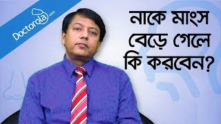 Hypertrophy nasal turbinates  নাকের মাংস বৃদ্ধি  নাকের মাংস বাড়লে করণীয়  Blocked nose relief [upl. by Four]