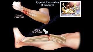 Types amp Mechanism Of Fractures  Everything You Need To Know  Dr Nabil Ebraheim [upl. by Mandych]