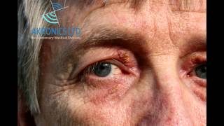 Xanthelasma Removal without TCA [upl. by Nylram]