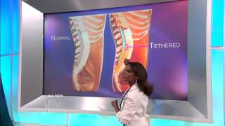 Tethered Cord Syndrome Explained Medical Course [upl. by Otokam602]