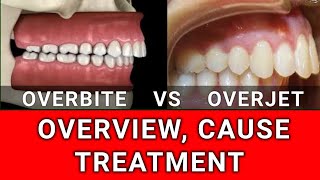 Overbite VS Overjet  Condition Overview Cause and Treatment [upl. by Kerwin]