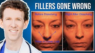 Under Eye Fillers Gone Wrong How to Fix Them [upl. by Obla]