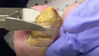 Ingrown Toe Nail Extraction Videos [upl. by Aneehsyt584]