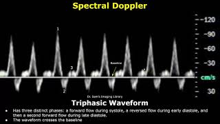 Monophasic Biphasic amp Triphasic Spectral Doppler Waveforms  Vascular Ultrasound Analysis USG [upl. by Brynna385]