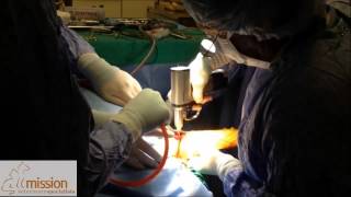 Canine Unicompartmental Elbow Procedure [upl. by Lagasse]