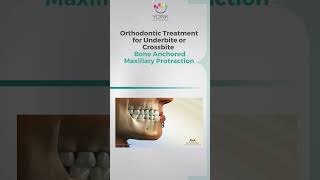 Orthodontic Treatment for Underbite or Crossbite Bone Anchored Maxillary Protraction [upl. by Horwath781]