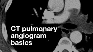 Pulmonary CT Angiogram Basics [upl. by Naehgem690]