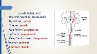 Pseudobulbar Palsy [upl. by Tiffany]