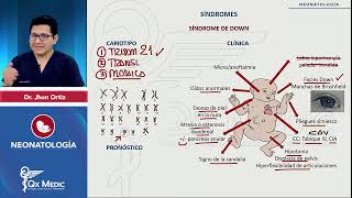 Síndrome 13 síndrome 21 síndrome 18  Neonatología 2024 [upl. by Atteinotna]