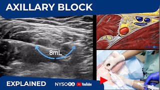 Ultrasound Guided Axillary Brachial Plexus Block NYSORA Regional Anesthesia [upl. by Lilyan128]