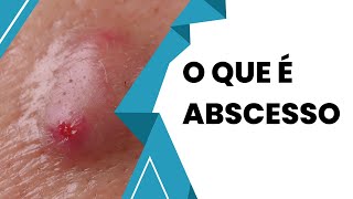 Descubra Tudo Sobre Abscesso e Como Tratar [upl. by Eiveneg]