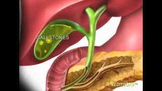 Acute Cholecystitis Gallbladder Attack Meditoons™ [upl. by Tabina]