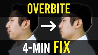 Overbite amp Overjet Fix｜Facial Asymmetry Correction｜Corrective Exercises [upl. by Ydok]