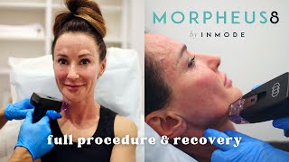 Morpheus 8 Radiofrequency  Microneedling Treatment Before amp After Full procedure amp recovery [upl. by Dion]