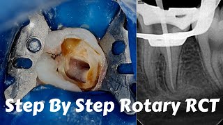 Live Steps Root Canal Rotary Protaper Endodontic Procedure ACP BMP obturation irrigation [upl. by Merce963]