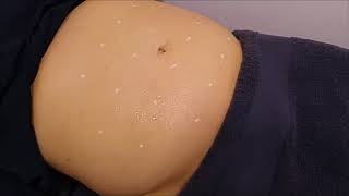 VÍDEO COMO HACER HIFU CORPORAL EN ABDOMEN [upl. by Monda]