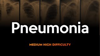 Lobar Pneumonia Chest Xray Quiz Medium to High Difficulty [upl. by Bobbi113]