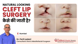 Cleft Lip and Palate Surgery which looks Natural by Dr Parit Ladani [upl. by Stirling]