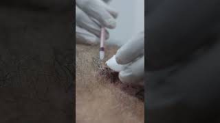 ILS Injection for Keloid Treatment get rid of Keloids with Skinaa Clinic shorts viralskinaclinic [upl. by Elocyn]