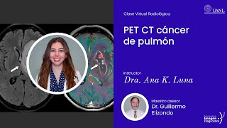 PET CT cáncer de pulmón por la Dra Ana K Luna Marroquín [upl. by Eniron]