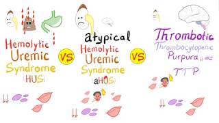 HUS vs aHUS vs TTP [upl. by Higginbotham]