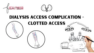 Dialysis Access Complication – Clotted Access Animation [upl. by Alahc]