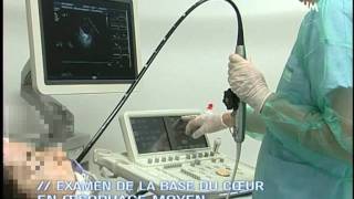 Echographie TransOesophagienne ETO  Film de formation [upl. by Drucie]