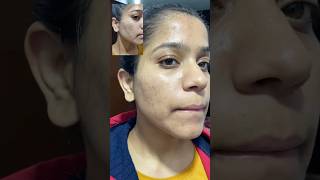 Tretinoin before and after 9month complete tretinoin face acne darkspots pimpleproblem [upl. by Reta]