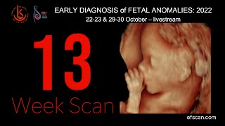 13 Week Scan  EARLY DIAGNOSIS of FETAL ANOMALIES 2022 [upl. by Eirual659]