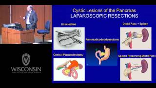 IPMNs of the Pancreas a Surgical Epidemic [upl. by Ralina]