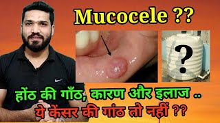 Mucocele होंठ की गांठ के कारण और इलाज [upl. by Nawad]