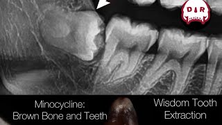 Minocycline Tooth Wisdom Tooth and Bone Stained with Tetracycline Wisdom Tooth Extraction Surgery [upl. by Azilef32]