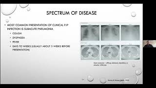 Pneumocystis jirovecii pneumonia  Current Issues in its Management [upl. by Peppi]