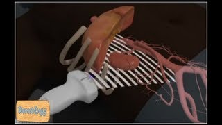 How to do ultrasound of kidney [upl. by Aihset]