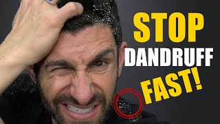 5 Tips On How To Get Rid Of Dandruff FAST Best Home Remedies Shampoos and Treatments [upl. by Dyna]