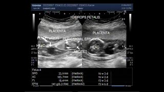 Hydrops fetalis with Fetal ascites pleural effusion pericardial effusion and Soft tissue edema [upl. by Ettelocin]