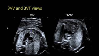 Fetal Echocardiography The 3VTV and identifying arch abnormalities [upl. by Rocker]