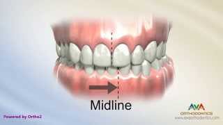 Orthodontic Treatment for Narrow Upper Jaw with Functional Shift  Expander or Spacer [upl. by Anaerdna]