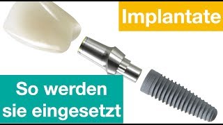 So werden Implantate eingesetzt [upl. by Akenahs877]