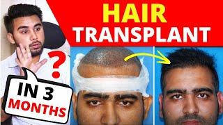 Comparing 3 Hair Transplant Results Of 4 Months  How Hair Looks Like 4 Months After Hair Transplant [upl. by Araiet398]